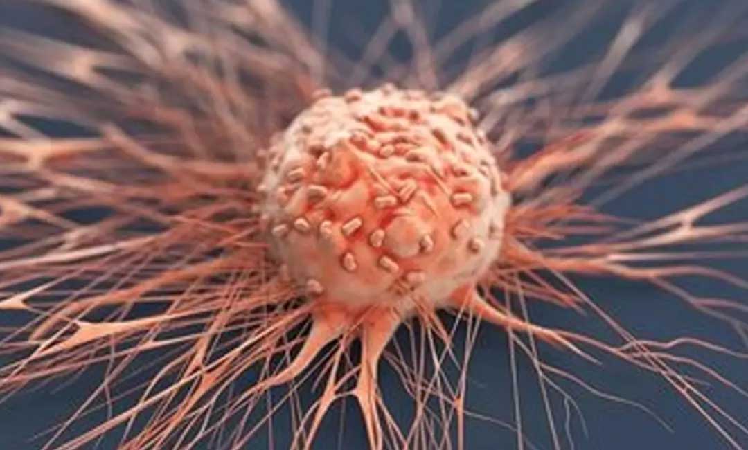 سرطان در اصفهان