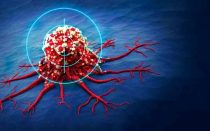 درمان سرطان سینه